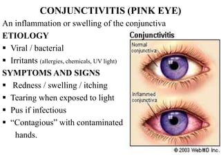 CONJUNCTIVITIS (PINK EYE)
An inflammation or swelling of the conjunctiva
ETIOLOGY
 Viral / bacterial
 Irritants (allergies, chemicals, UV light)
SYMPTOMS AND SIGNS
 Redness / swelling / itching
 Tearing when exposed to light
 Pus if infectious
 “Contagious” with contaminated
hands.
 