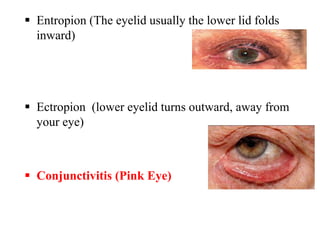  Entropion (The eyelid usually the lower lid folds
inward)
 Ectropion (lower eyelid turns outward, away from
your eye)
 Conjunctivitis (Pink Eye)
 