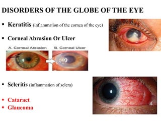 DISORDERS OF THE GLOBE OF THE EYE
 Keratitis (inflammation of the cornea of the eye)
 Corneal Abrasion Or Ulcer
 Scleritis (inflammation of sclera)
 Cataract
 Glaucoma
 