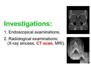 Investigations:
1. Endoscopical examinations.
2. Radiological examinations:
(X-ray sinuses, CT scan, MRI).
 