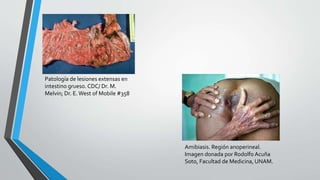 Patología de lesiones extensas en
intestino grueso. CDC/ Dr. M.
Melvin; Dr. E.West of Mobile #358
Amibiasis. Región anoperineal.
Imagen donada por Rodolfo Acuña
Soto, Facultad de Medicina, UNAM.
 