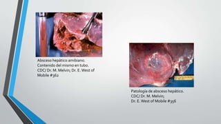 Absceso hepático amibiano.
Contenido del mismo en tubo.
CDC/ Dr. M. Melvin; Dr. E.West of
Mobile #362
Patología de absceso hepático.
CDC/ Dr. M. Melvin;
Dr. E.West of Mobile #356
 