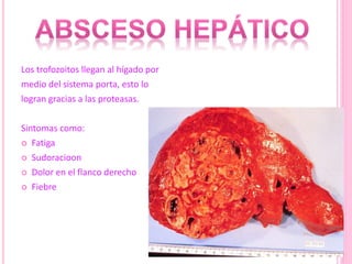 Los trofozoitos llegan al hígado por
medio del sistema porta, esto lo
logran gracias a las proteasas.
Sintomas como:
 Fatiga
 Sudoracioon
 Dolor en el flanco derecho
 Fiebre
 