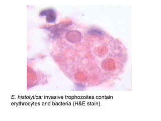 E. histolytica: invasive trophozoites contain
erythrocytes and bacteria (H&E stain).
 