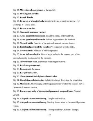 Fig. 14. Microtia and appendages of the auricle.
Fig. 15. Sticking out auricles.
Fig. 16. Parotic fistula.
Fig. 17. Removal of a foreign body from the external acoustic meatus: a – by
washing; b – with a hook.
Fig. 18. Furuncle section.
Fig. 19. Traumatic eardrum rupture.
Fig. 20. Acute purulent otitis media. Local hyperemia of the eardrum.
Fig. 21. Acute purulent otitis media. Diffuse hyperemia of the eardrum.
Fig. 22. Necrotic otitis. Necrosis of the external acoustic meatus tissues.
Fig. 23. Peripheral paresis of the facial nerve in case of necrotic otitis.
Fig. 24. Necrotic otitis. Necrosis of mastoid process.
Fig. 25. Acute influenzal otitis. Hemorrhagic bullae in the osseous part of the
external acoustic meatus and on the eardrum.
Fig. 26. Tuberculosus otitis. Numerous eardrum perforations.
Fig. 27. Eardrum paracentesis.
Fig. 28. Paracentesis foramen.
Fig. 29. Ear politzerization.
Fig. 30. The scheme of otosalpinx catheterization.
Fig. 31. Otosalpinx catheterization. Administration of drugs into the otosalpinx.
Fig. 32. Mastoiditis. Overhanging of the superoposterior wall in the osseous part of
the external acoustic meatus.
Fig. 33. Roentgenography of the mastoid process of temporal bone. Normal
variant.
Fig. 34. A step of antromastoidotomy. The place of incision.
Fig. 35. A step of antromastoidotomy. Moving tissues aside in the mastoid process
region.
Fig. 36. A step of antromastoidotomy. The region of the Chipault’s triangle.
221
 