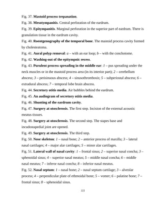 Fig. 37. Mastoid process trepanation.
Fig. 38. Mesotympanitis. Central perforation of the eardrum.
Fig. 39. Epitympanitis. Marginal perforation in the superior part of eardrum. There is
granulation tissue in the eardrum cavity.
Fig. 40. Roentgenography of the temporal bone. The mastoid process cavity formed
by cholesteatoma.
Fig. 41. Aural polyp removal: a – with an ear loop; b – with the conchotome.
Fig. 42. Washing-out of the epitympnic recess.
Fig. 43. Purulent process spreading in the middle ear: 1 – pus spreading under the
neck muscles or in the mastoid process area (in its interior part); 2 – cerebellum
abscess; 3 – perisinuous abscess; 4 – sinusothrombosis; 5 – subperiostal abscess; 6 –
extradural abscess; 7 – temporal lobe brain abscess.
Fig. 44. Secretory otitis media. Air bubbles behind the eardrum.
Fig. 45. An audiogram of secretory otitis media.
Fig. 46. Shunting of the eardrum cavity.
Fig. 47. Surgery at otosclerosis. The first step. Incision of the external acoustic
meatus tissues.
Fig. 48. Surgery at otosclerosis. The second step. The stapes base and
incudostapedial joint are opened.
Fig. 49. Surgery at otosclerosis. The third step.
Fig. 50. Nose skeleton: 1 – nasal bone; 2 – anterior process of maxilla; 3 – lateral
nasal cartilages; 4 – major alar cartilages; 5 – minor alar cartilages.
Fig. 51. Lateral wall of nasal cavity: 1 – frontal sinus; 2 – superior nasal concha; 3 –
sphenoidal sinus; 4 – superior nasal meatus; 5 – middle nasal concha; 6 – middle
nasal meatus; 7 – inferor nasal concha; 8 – inferior nasal meatus.
Fig. 52. Nasal septum: 1 – nasal bone; 2 – nasal septum cartilage; 3 – alveolar
process; 4 – perpendicular plate of ethmoidal bone; 5 – vomer; 6 – palatine bone; 7 –
frontal sinus; 8 – sphenoidal sinus.
222
 