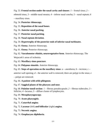Fig. 53. Frontal section under the nasal cavity and sinuses: 1 – frontal sinus; 2 –
ethmoid sinus; 3 – middle nasal meatus; 4 – inferor nasal concha; 5 – nasal septum; 6
– maxillary sinus.
Fig. 54. Posterior rhinoscopy.
Fig. 55. Reposition of the nasal bones.
Fig. 56. Anterior nasal packing.
Fig. 57. Posterior nasal packing.
Fig. 58. Nasal septum deviation.
Fig. 59. Hypertrophy of the posterior ends of inferior nasal turbinates.
Fig. 60. Ozena. Anterior rhinoscopy.
Fig. 61. Ozena. Posterior rhinoscopy.
Fig. 62. Vasculomotor rhinitis, neurovegetative form. Anterior rhinoscopy. The
Wojaczek’s areas of ischemia.
Fig. 63. Maxillary sinus puncture.
Fig. 64. Polypous sinusitis. Anterior rhinoscopy.
Fig. 65. Steps of operation on the maxillary sinus: a – anesthesia; b – incision; c –
anterior wall opening; d – the anterior wall is removed, there are polypi in the sinus; e
– polypi are removed.
Fig. 66. A patient with orbit phlegmon.
Fig. 67. Saggital planes of the pharynx and nose.
Fig. 68. Palatine tonsil section: 1 – fibrous pseudocapsule; 2 – fibrous trabecules; 3 –
follicles; 4 –lacunas; 5 – diffuse cluster of lymphocytes.
Fig. 69. Mesopharyngoscopy.
Fig. 70. Acute pharyngitis.
Fig. 71. Catarrhal angina.
Fig. 72. Lacunar (left) and follicular (right) angina.
Fig. 73. Necrotic angina.
Fig. 74. Oropharynx diphtheria.
223
 