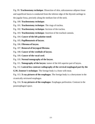 Fig. 99. Tracheostomy technique. Dissection of skin, subcutaneous adipose tissue
and superficial fascia is conducted from the inferior edge of the thyroid cartilage to
the jugular fossa, precisely along the medium line of the neck.
Fig. 100. Tracheostomy technique.
Fig. 101. Tracheostomy technique. The rings of trachea.
Fig. 102. Tracheostomy technique. Incision of the trachea.
Fig. 103. Tracheostomy technique. Insertion of the tracheal cannula.
Fig. 104. Cancer of the left palatine tonsil.
Fig. 105. Papillomatosis of larynx.
Fig. 106. Fibroma of larynx.
Fig. 107. Removal of laryngeal fibroma.
Fig. 108. Cancer of the vestibule of larynx.
Fig. 109. Cancer of the vocal cord.
Fig. 110. Normal tomography of the larynx.
Fig. 111. Tomography of the larynx: tumor of the left superior part of larynx.
Fig. 112. Lateral low-contrast radiography of the cervical esophageal part by the
G.M. Zemtsov’s technique. The foreign body is a bone with meat.
Fig. 113. X-ray pictures of the esophagus. The foreign body is a cherrystone in the
cicatrically strictured esophagus.
Fig. 114. X-ray pictures of the esophagus. Esophagus perforation. Contrast in the
paraesophageal space.
225
 