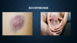ECCHYMOSIS
 