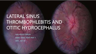 LATERAL SINUS
THROMBOPHLEBITIS AND
OTITIC HYDROCEPHALUS
MALIPEDDI TARUN
MBBS FINAL YEAR PART 1
ROLL NO 74
 
