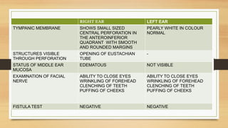 RIGHT EAR LEFT EAR
TYMPANIC MEMBRANE SHOWS SMALL SIZED
CENTRAL PERFORATION IN
THE ANTEROINFERIOR
QUADRANT WITH SMOOTH
AND ROUNDED MARGINS
PEARLY WHITE IN COLOUR
NORMAL
STRUCTURES VISIBLE
THROUGH PERFORATION
OPENING OF EUSTACHIAN
TUBE
-
STATUS OF MIDDLE EAR
MUCOSA
EDEMATOUS NOT VISIBLE
EXAMINATION OF FACIAL
NERVE
ABILITY TO CLOSE EYES
WRINKLING OF FOREHEAD
CLENCHING OF TEETH
PUFFING OF CHEEKS
ABILITY TO CLOSE EYES
WRINKLING OF FOREHEAD
CLENCHING OF TEETH
PUFFING OF CHEEKS
FISTULA TEST NEGATIVE NEGATIVE
 