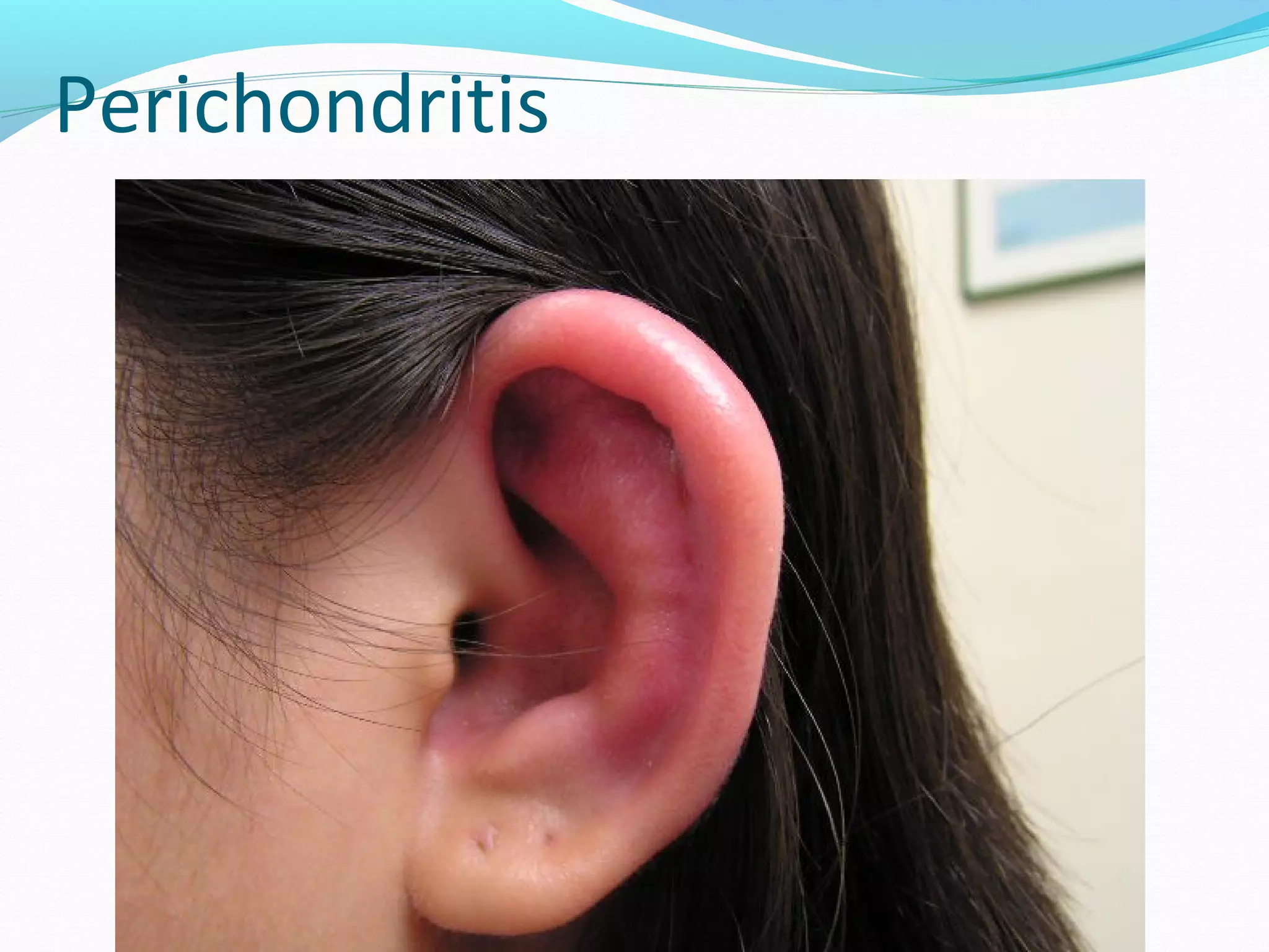 Perichondritis

 
