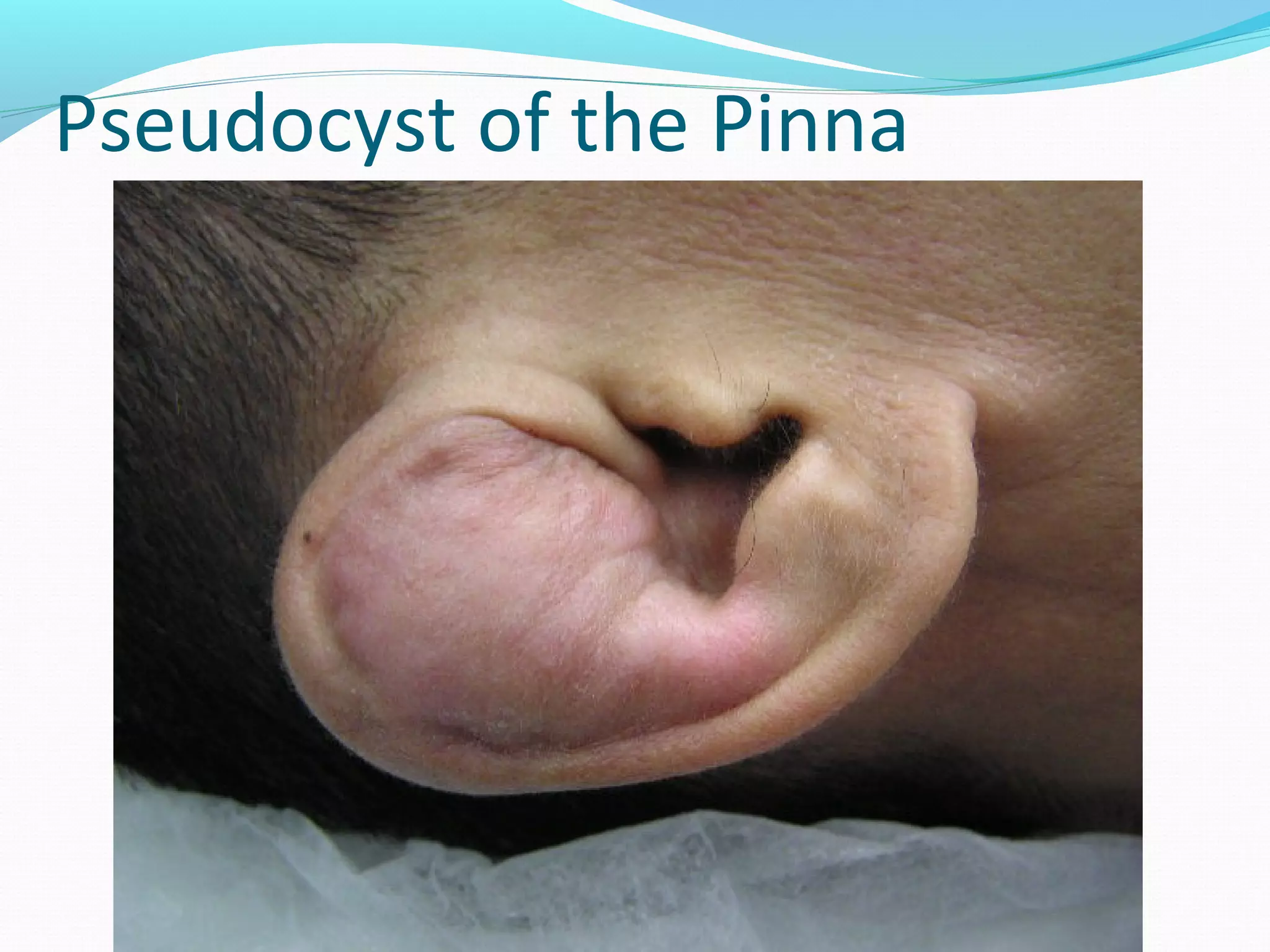 Pseudocyst of the Pinna

 