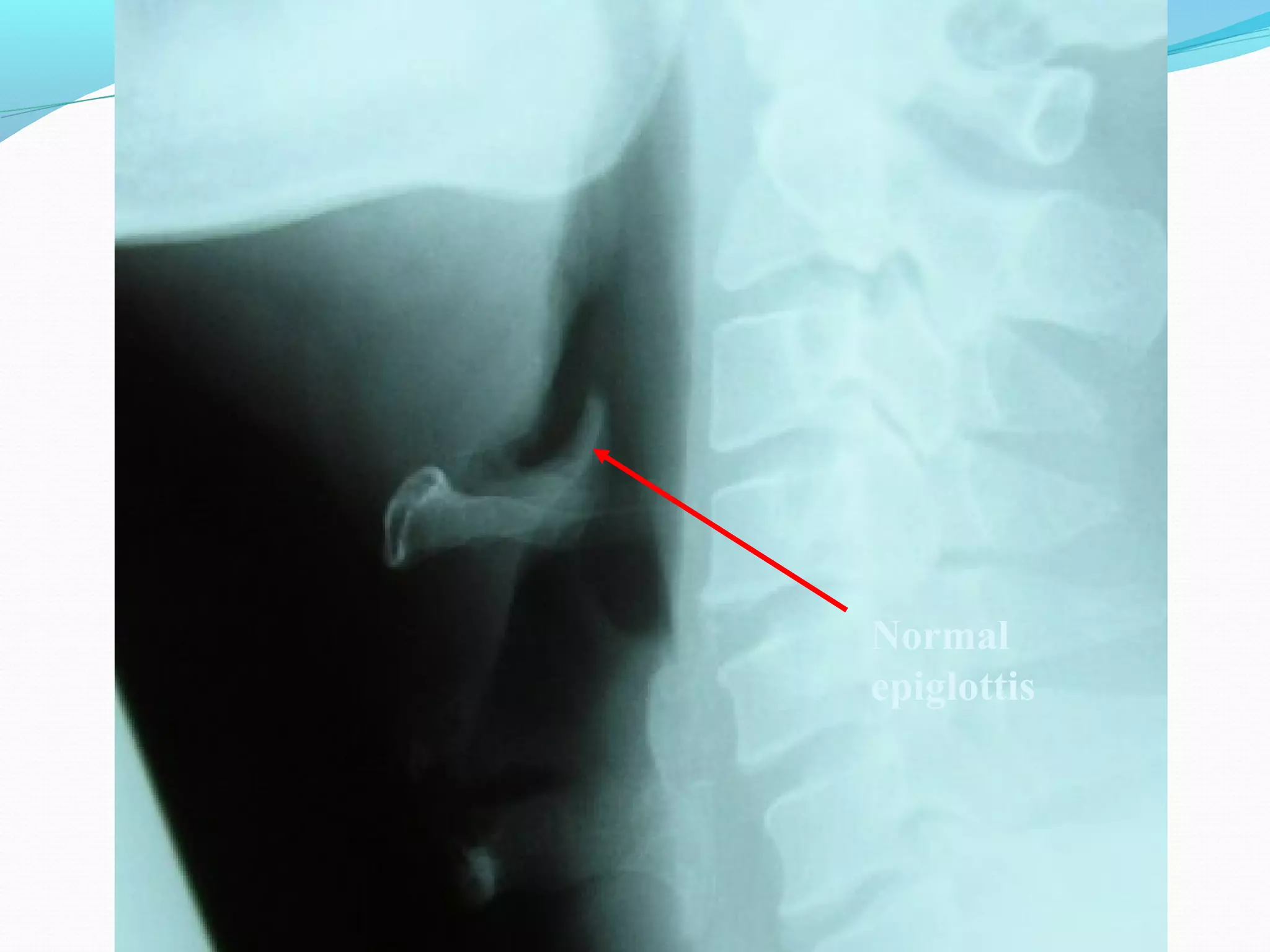 Normal
epiglottis

 