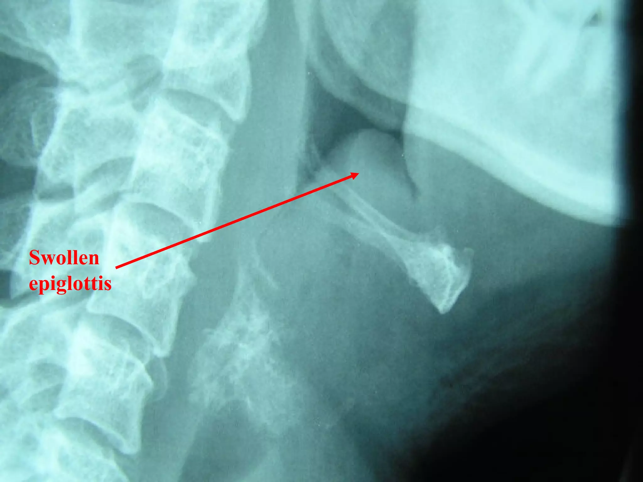 Swollen
epiglottis

 