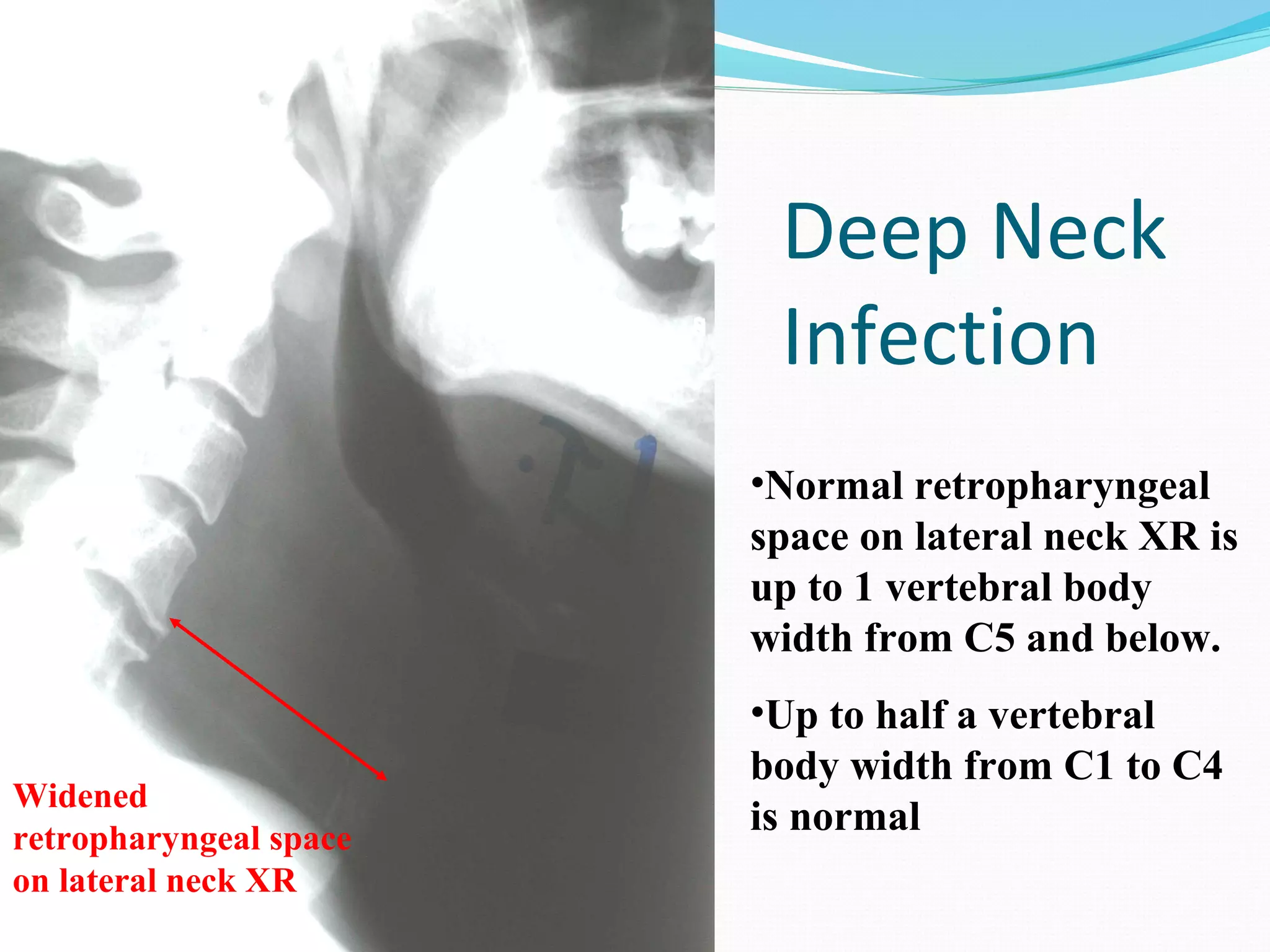 Deep Neck
Infection
•Normal retropharyngeal
space on lateral neck XR is
up to 1 vertebral body
width from C5 and below.

Widened
retropharyngeal space
on lateral neck XR

•Up to half a vertebral
body width from C1 to C4
is normal

 