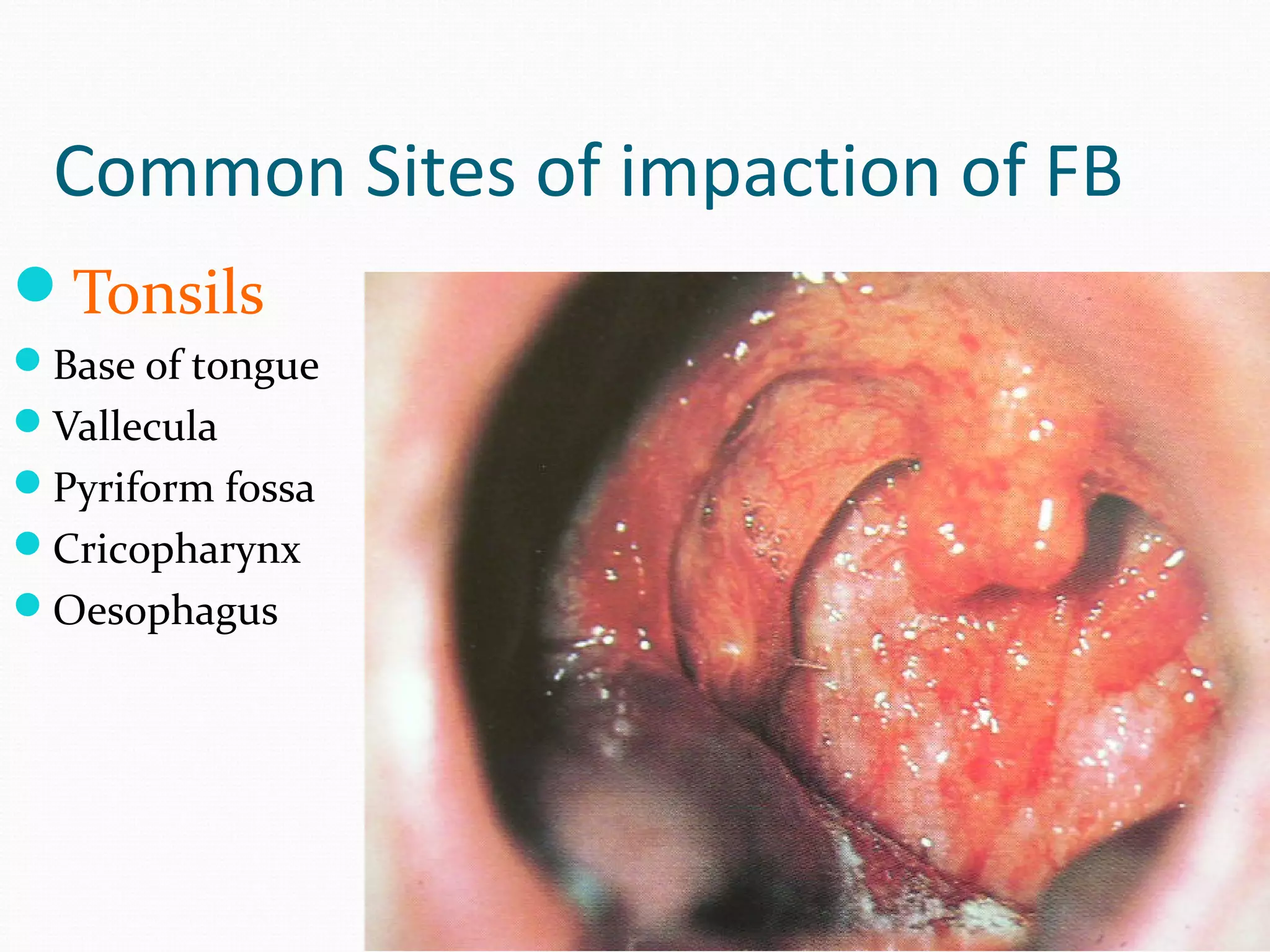 Common Sites of impaction of FB
Tonsils
Base of tongue
Vallecula
Pyriform fossa
Cricopharynx
Oesophagus

 