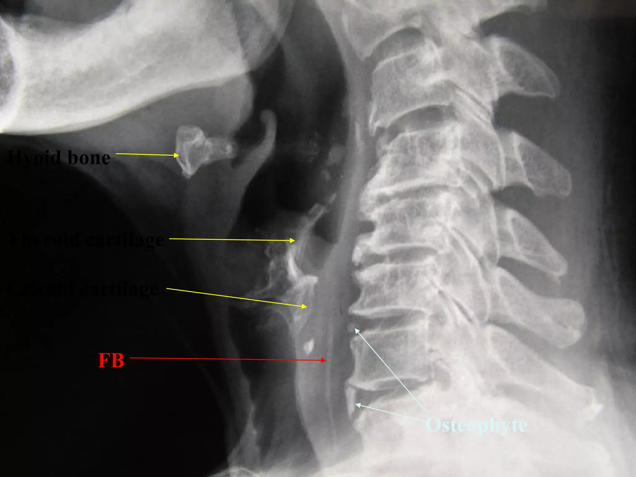 Hyoid bone

Thyroid cartilage
Cricoid cartilage
FB
Osteophyte

 