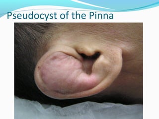 Pseudocyst of the Pinna

 