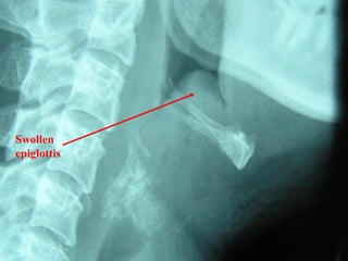 Swollen
epiglottis

 