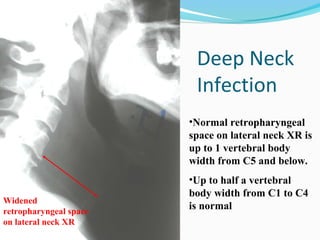 Deep Neck
Infection
•Normal retropharyngeal
space on lateral neck XR is
up to 1 vertebral body
width from C5 and below.

Widened
retropharyngeal space
on lateral neck XR

•Up to half a vertebral
body width from C1 to C4
is normal

 