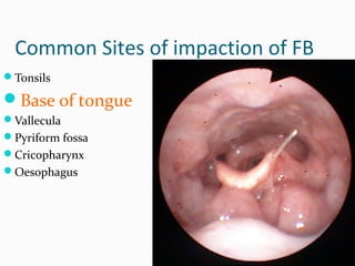 Common Sites of impaction of FB
Tonsils

Base of tongue
Vallecula
Pyriform fossa
Cricopharynx
Oesophagus

 
