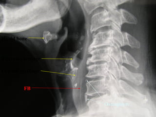 Hyoid bone

Thyroid cartilage
Cricoid cartilage
FB
Osteophyte

 