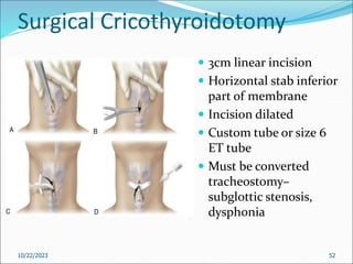 Surgical Cricothyroidotomy
 3cm linear incision
 Horizontal stab inferior
part of membrane
 Incision dilated
 Custom tube or size 6
ET tube
 Must be converted
tracheostomy–
subglottic stenosis,
dysphonia
10/22/2023 52
 