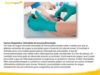 Exames Diagnóstico: Velocidade de hemossedimentação
Um teste de sangue chamado velocidade de hemossedimentação mede a rapidez com que os
glóbulos vermelhos do sangue se precipitam para o fundo de um tubo de ensaio. O resultado é
utilizado como uma medida aproximada da inflamação das articulações. A taxa de
hemossedimentação mais rápida indica inflamação que pode corresponder às crises da doença, um
resultado mais lento pode ser observado durante as remissões. Outro exame de sangue, que é usado
para medir o grau de inflamação presente no organismo é a proteína C-reactiva. O fator reumatóide,
ANA, hemossedimentação e a proteína C reativa também podem ser anormais em outras condições
inflamatórias sistêmicas auto-imunes. Portanto, anormalidades nestes exames de sangue
isoladamente não são suficientes para o diagnóstico da artrite reumatóide.
 
