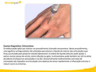 Exames Diagnóstico: Artrocentese
O médico pode optar por realizar um procedimento chamado artrocentese. Neste procedimento,
uma agulha e seringa estéreis são utilizados para drenar o líquido do interior das articulações que
ficou acumulado para posterior estudo laboratorial. A análise do líquido articular pode ajudar a
excluir outras causas de artrite, como infecção ou gota. A artrocentese pode também ser útil no alívio
do edema (inchaço) nas articulações e na dor. Ocasionalmente medicamentos com base de
corticoides são injetados na articulação com objetivo de aliviar rapidamente a inflamação articular e
reduzir assim os sintomas.
 