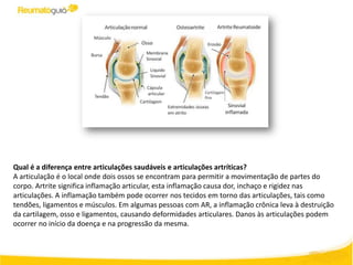 Qual é a diferença entre articulações saudáveis ​e articulações artríticas?
A articulação é o local onde dois ossos se encontram para permitir a movimentação de partes do
corpo. Artrite significa inflamação articular, esta inflamação causa dor, inchaço e rigidez nas
articulações. A inflamação também pode ocorrer nos tecidos em torno das articulações, tais como
tendões, ligamentos e músculos. Em algumas pessoas com AR, a inflamação crônica leva à destruição
da cartilagem, osso e ligamentos, causando deformidades articulares. Danos às articulações podem
ocorrer no início da doença e na progressão da mesma.
 