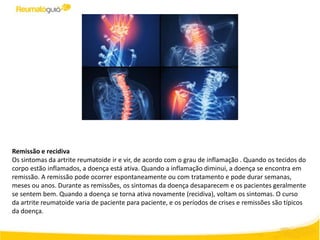 Remissão e recidiva
Os sintomas da artrite reumatoide ir e vir, de acordo com o grau de inflamação . Quando os tecidos do
corpo estão inflamados, a doença está ativa. Quando a inflamação diminui, a doença se encontra em
remissão. A remissão pode ocorrer espontaneamente ou com tratamento e pode durar semanas,
meses ou anos. Durante as remissões, os sintomas da doença desaparecem e os pacientes geralmente
se sentem bem. Quando a doença se torna ativa novamente (recidiva), voltam os sintomas. O curso
da artrite reumatoide varia de paciente para paciente, e os períodos de crises e remissões são típicos
da doença.
 