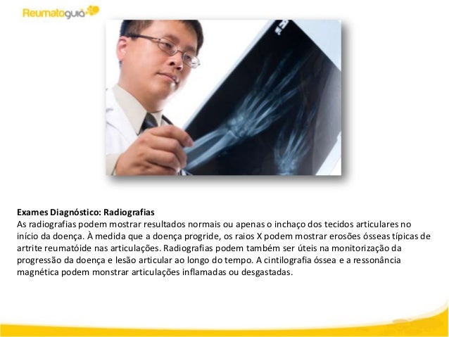 Exames para detectar artrite reumatoide