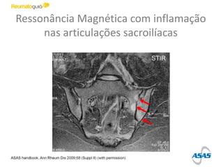 Ressonância Magnética com inflamação
nas articulações sacroilíacas
 