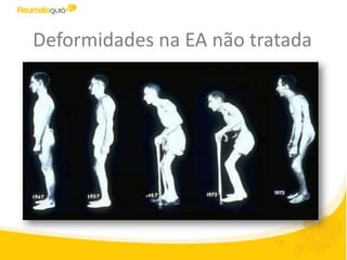 Deformidades na EA não tratada
 