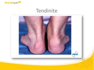 Tendinite
 