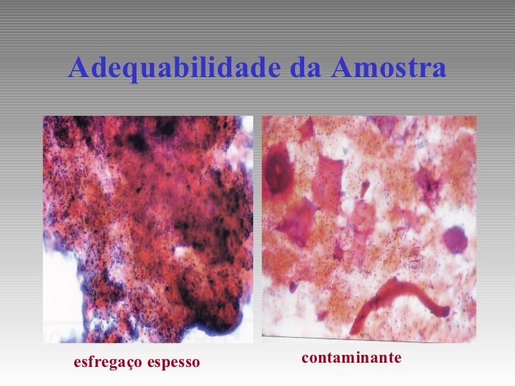 Alterações Celulares Benignas Reativas Ou Reparativas Associadas A Inflamação