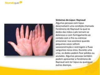 Sintomas do Lúpus: Raynaud
Algumas pessoas com lúpus
desenvolvem uma condição chamada
Fenômeno de Raynaud na qual os
dedos das mãos e pés tornam-se
dolorosos e com formigamento ao
contato com o frio ou estresse
emocional. Isso acontece quando
pequenos vasos sofrem
vasoconstricção e restringem o fluxo
sanguíneo nessa área. Durante uma
crise, os dedos podem ficar pálidos ou
azulados. Algumas pessoas também
podem apresentar o Fenômeno de
Raynaud sem ter lúpus ou quaisquer
outras doenças.
 