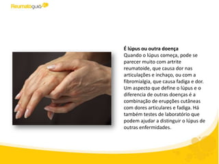 É lúpus ou outra doença
Quando o lúpus começa, pode se
parecer muito com artrite
reumatoide, que causa dor nas
articulações e inchaço, ou com a
fibromialgia, que causa fadiga e dor.
Um aspecto que define o lúpus e o
diferencia de outras doenças é a
combinação de erupções cutâneas
com dores articulares e fadiga. Há
também testes de laboratório que
podem ajudar a distinguir o lúpus de
outras enfermidades.
 