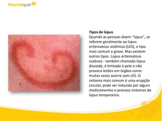 Tipos de lúpus
Quando as pessoas dizem "lúpus", se
referem geralmente ao lúpus
eritematoso sistêmico (LES), o tipo
mais comum e grave. Mas existem
outros tipos. Lúpus eritematoso
cutâneo - também chamado lúpus
discoide, é limitado à pele e não
provoca lesões em órgãos como
muitas vezes ocorre com o LES. O
sintoma mais comum é uma erupção
circular que pode ser induzida por
alguns medicamentos e provoca
sintomas do lúpus temporários.
 