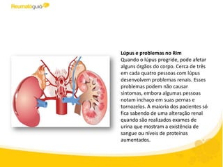 Lúpus e problemas no Rim
Quando o lúpus progride, pode afetar
alguns órgãos do corpo. Cerca de três
em cada quatro pessoas com lúpus
desenvolvem problemas renais. Esses
problemas podem não causar
sintomas, embora algumas pessoas
notam inchaço em suas pernas e
tornozelos. A maioria dos pacientes só
fica sabendo de uma alteração renal
quando são realizados exames de
urina que mostram a existência de
sangue ou níveis de proteínas
aumentados.
 