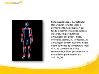 Sintomas do Lúpus: Dor articular
Dor articular é muitas vezes o
primeiro sintoma de lúpus. A dor
tende a ocorrer em ambos os lados
do corpo, em particular nas
articulações dos pulsos, mãos,
cotovelos, joelhos, ou tornozelos. As
articulações podem estar inflamadas
e com aumento de temperatura local.
Mas, ao contrário da artrite
reumatoide, o lúpus geralmente não
causa danos permanentes nas
articulações.
 