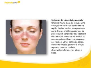 Sintomas do Lúpus: Eritema malar
Um sinal muito claro de lúpus é uma
erupção em forma de borboleta na
região das bochechas e na ponte do
nariz. Outros problemas comuns da
pele incluem sensibilidade ao sol com
descamação, manchas vermelhas ou
uma erupção cutânea, escamosa de
cor roxo em rosto, pescoço e braços.
Algumas pessoas também podem
apresentar feridas nos lábios e boca.
 