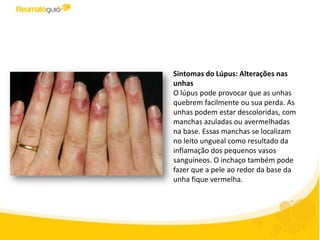 Sintomas do Lúpus: Alterações nas
unhas
O lúpus pode fazer que as unhas
quebrem facilmente ou sua perda. As
unhas podem estar descoloridas, com
manchas azuladas ou avermelhadas
na base. Essas manchas se localizam
no leito ungueal como resultado da
inflamação dos pequenos vasos
sanguíneos. O inchaço também pode
fazer que a pele ao redor da base da
unha fique vermelha.
 