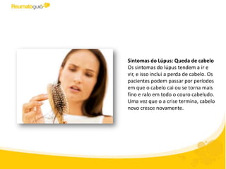 Sintomas do Lúpus: Queda de cabelo
Os sintomas do lúpus tendem a ir e
vir, e isso inclui a perda de cabelo. Os
pacientes podem passar por períodos
em que o cabelo cai ou se torna mais
fino e ralo em todo o couro cabeludo.
Uma vez que o a crise termina, cabelo
novo cresce novamente.
 