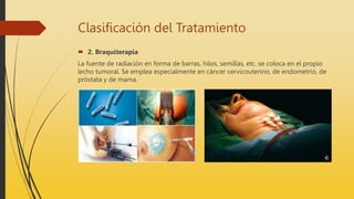 Clasificación del Tratamiento
 2. Braquiterapia
La fuente de radiación en forma de barras, hilos, semillas, etc. se coloca en el propio
lecho tumoral. Se emplea especialmente en cáncer cervicouterino, de endometrio, de
próstata y de mama.
 
