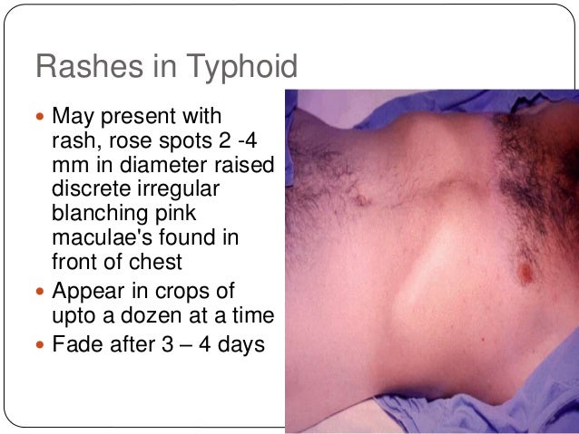 typhoid shot side effect typhoid shot side effect