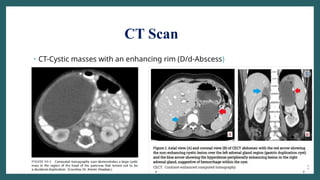 CT Scan
• CT-Cystic masses with an enhancing rim (D/d-Abscess)
 