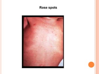 Rose spots
 