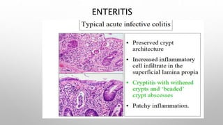Enteritis | PPTX
